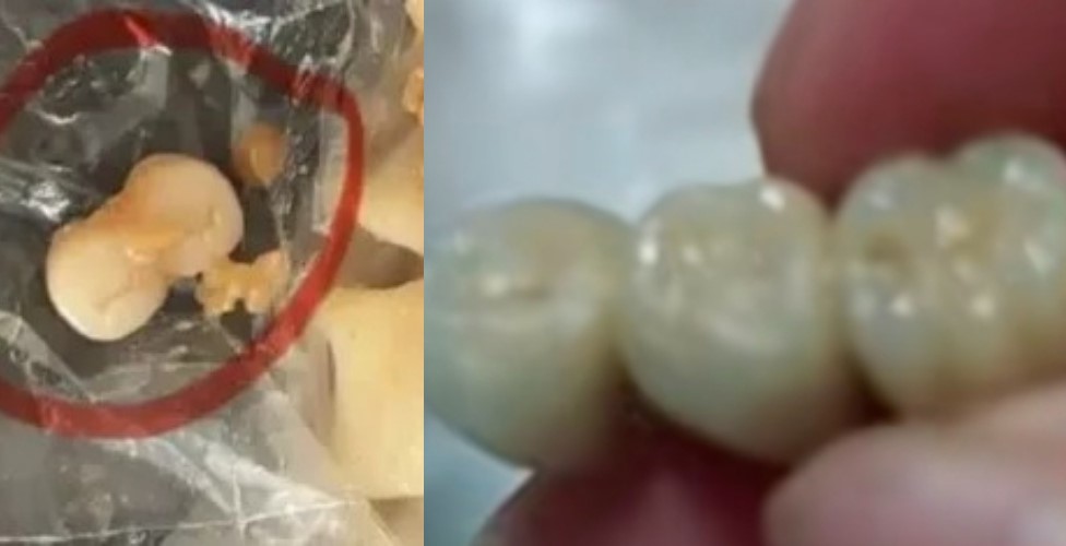 中國婦人在香腸裡咬到3顆完整牙齒，引發全網恐慌。（翻攝自小紅書）