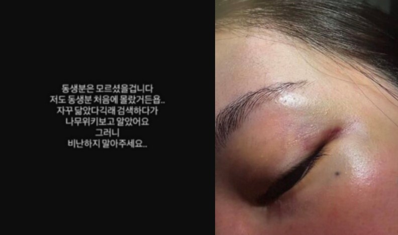 疑似JISOO大嫂的網友公開遭到家暴的傷勢照，並發聲請求社會大眾不要將怒火延燒至無辜的JISOO身上。（圖／翻攝自 Instagram）