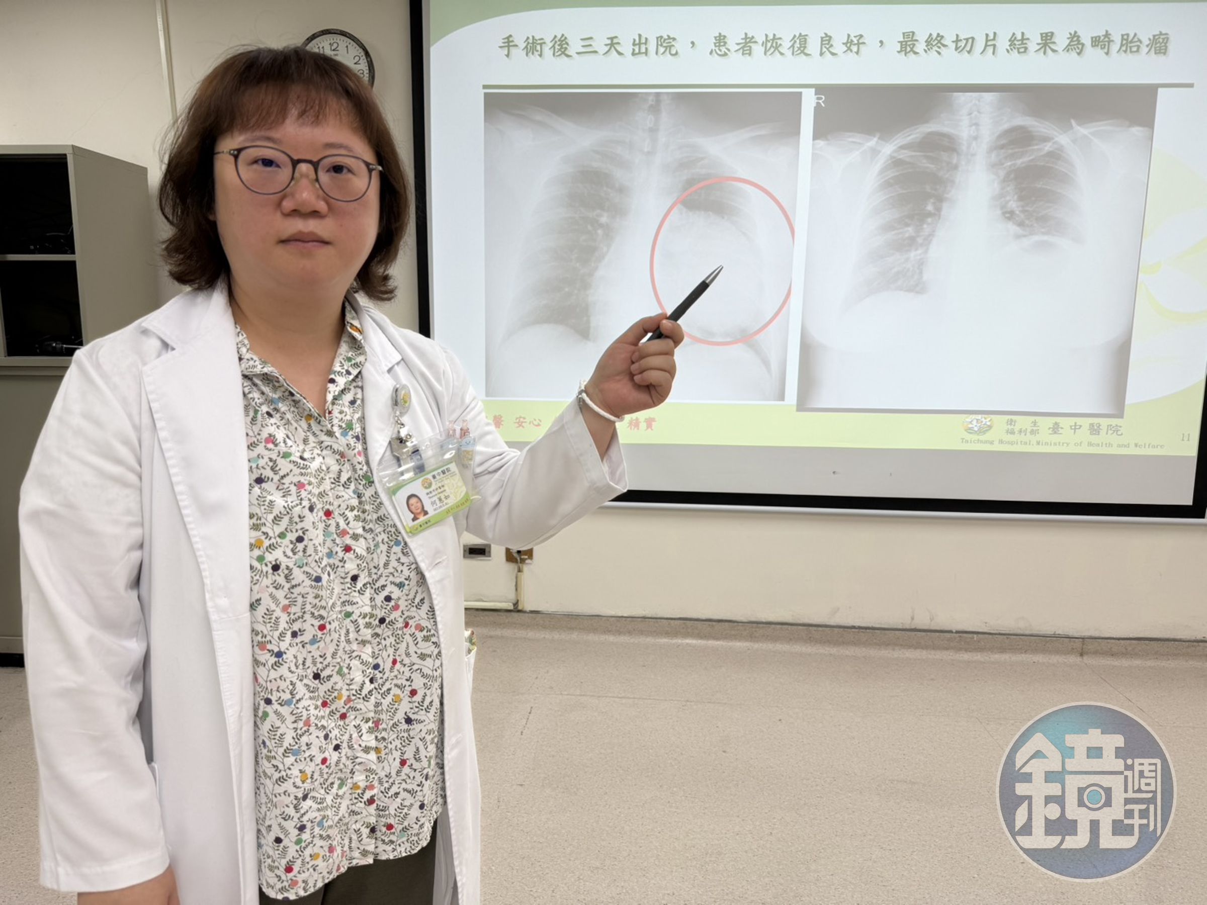 何蕙如醫師說明患者開刀前,左側縱隔腔巨大腫瘤幾乎把左肺壓扁(左圖),術後恢復了左肺應有的空間(右圖)。(醫院提供)