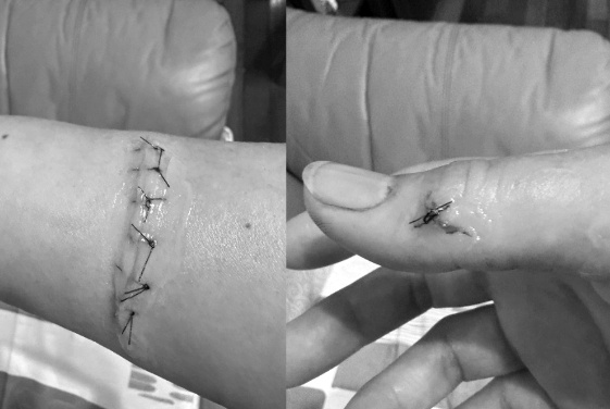 全聯保鮮碗爆裂導致手部肌腱斷裂，受害民眾緊急送醫縫數針。（翻攝自臉書 @全聯消費經驗老實說）