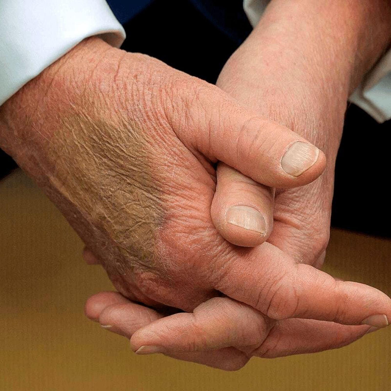 川普近年頻頻被拍到右手背上出現大片瘀青，還需用粉底液遮掩。（翻攝X@ProjectLincoln）