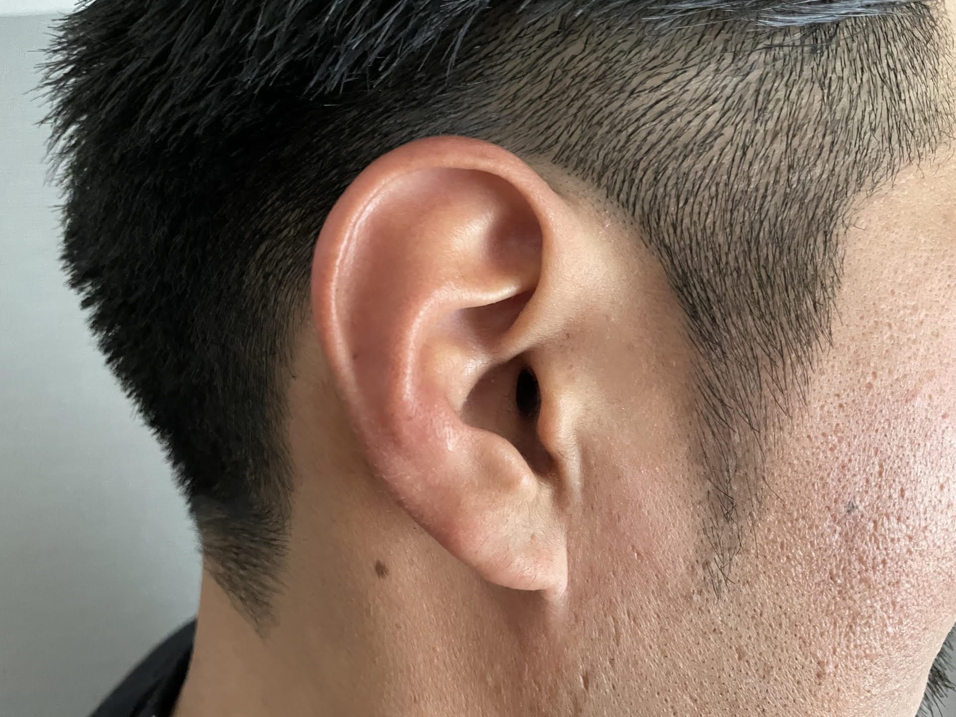 吳仁欽提醒病毒疣不僅會長大還會向外擴散,如果耳朵長出怪東西,要趁早治療。(示意圖,photoAC)