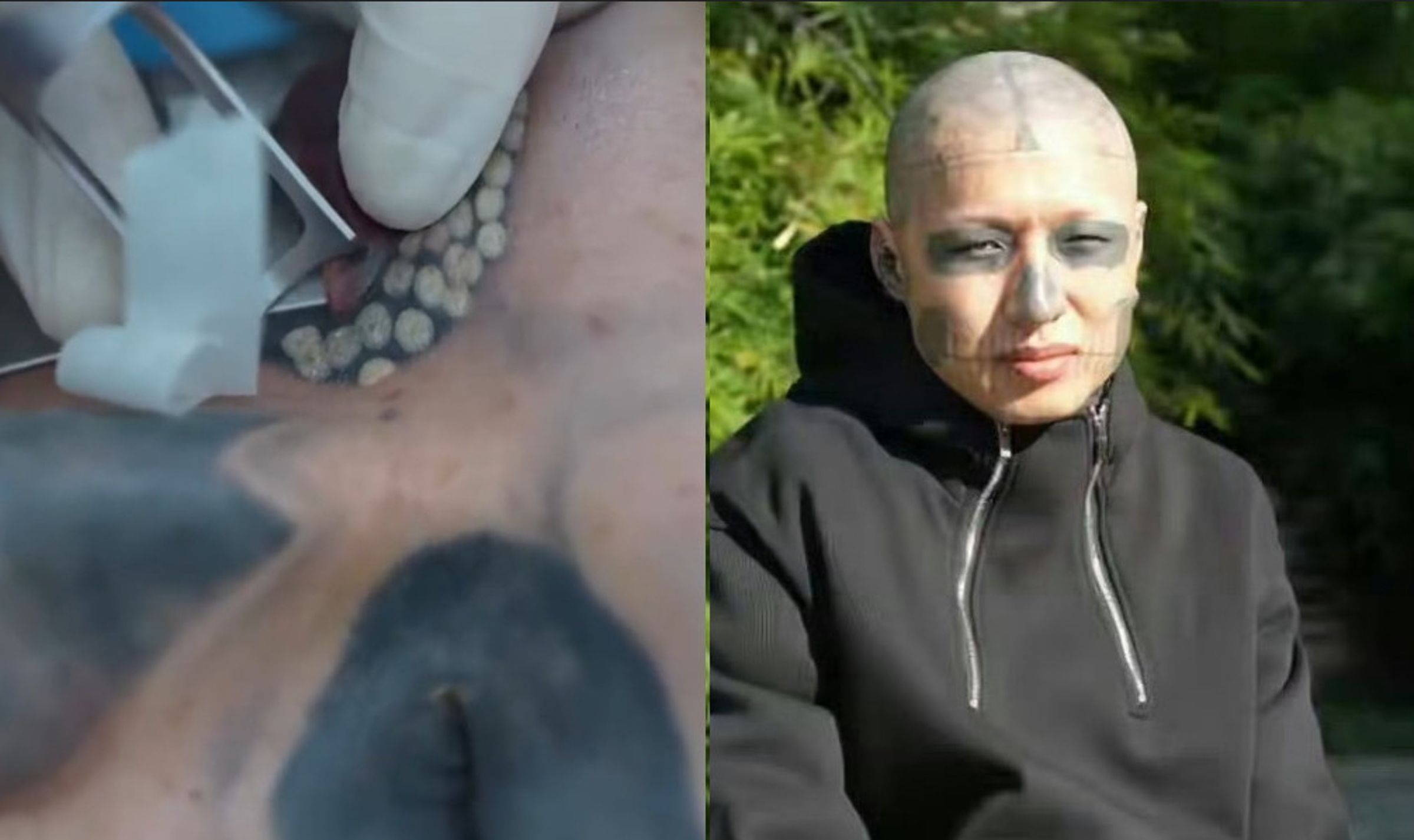 男子決心清除全身刺青，但因無法忍耐過程中的劇痛，只能暫時中斷。（翻攝微博）