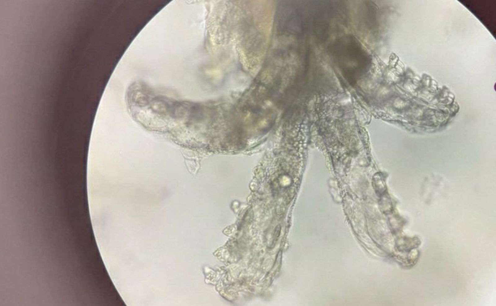 「妳臉上在養蟲」不是清潔不夠!她臉粗紅疹狂冒 醫師驚:毛孔住滿8腳蟲...揭4大警訊