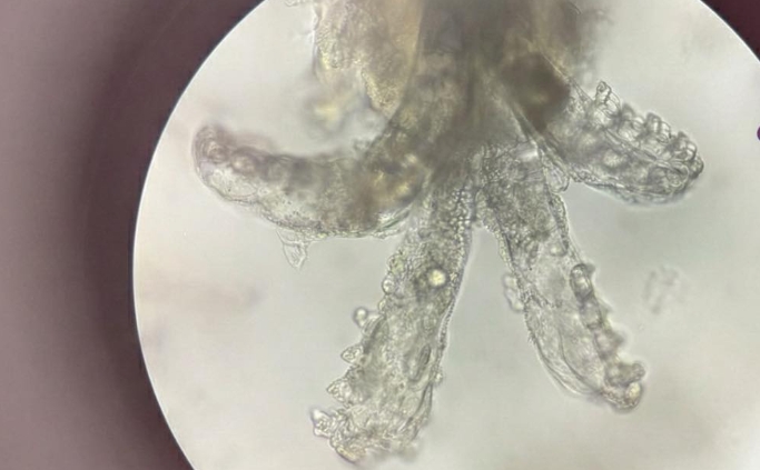 醫師提醒,亂擦類固醇恐助長蟎蟲大量繁殖。(翻攝自臉書/王佑鑫 皮膚專科醫師)