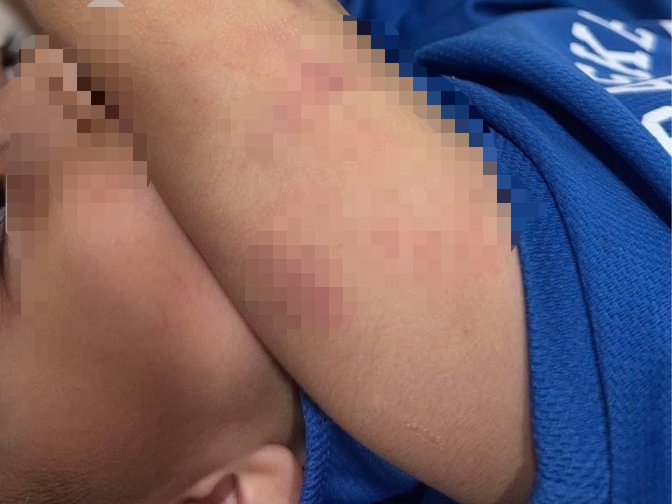 被害家長在孩子手上發現多處不明瘀青，赫然發現孩子在幼兒園遭虐，憤而驗傷揭露教保員暴行。翻攝百福社區好厝邊臉書