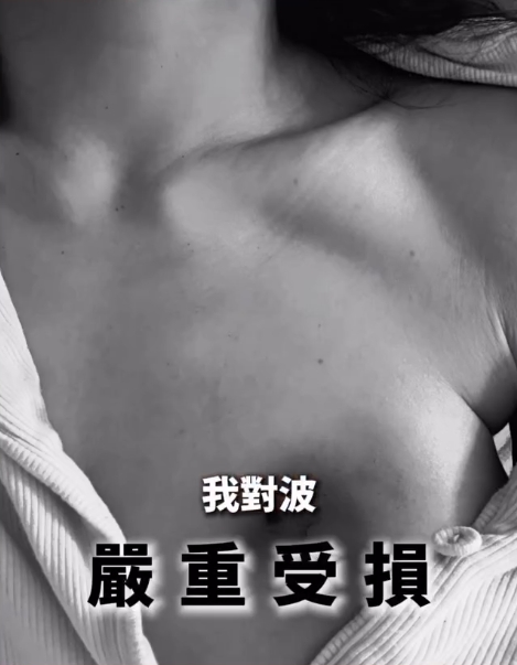 香港「最強小三」鍾睿心胸部被燙傷留下疤痕,還出現傷口感染。(翻攝自IG@5kidsokma_no1fans)