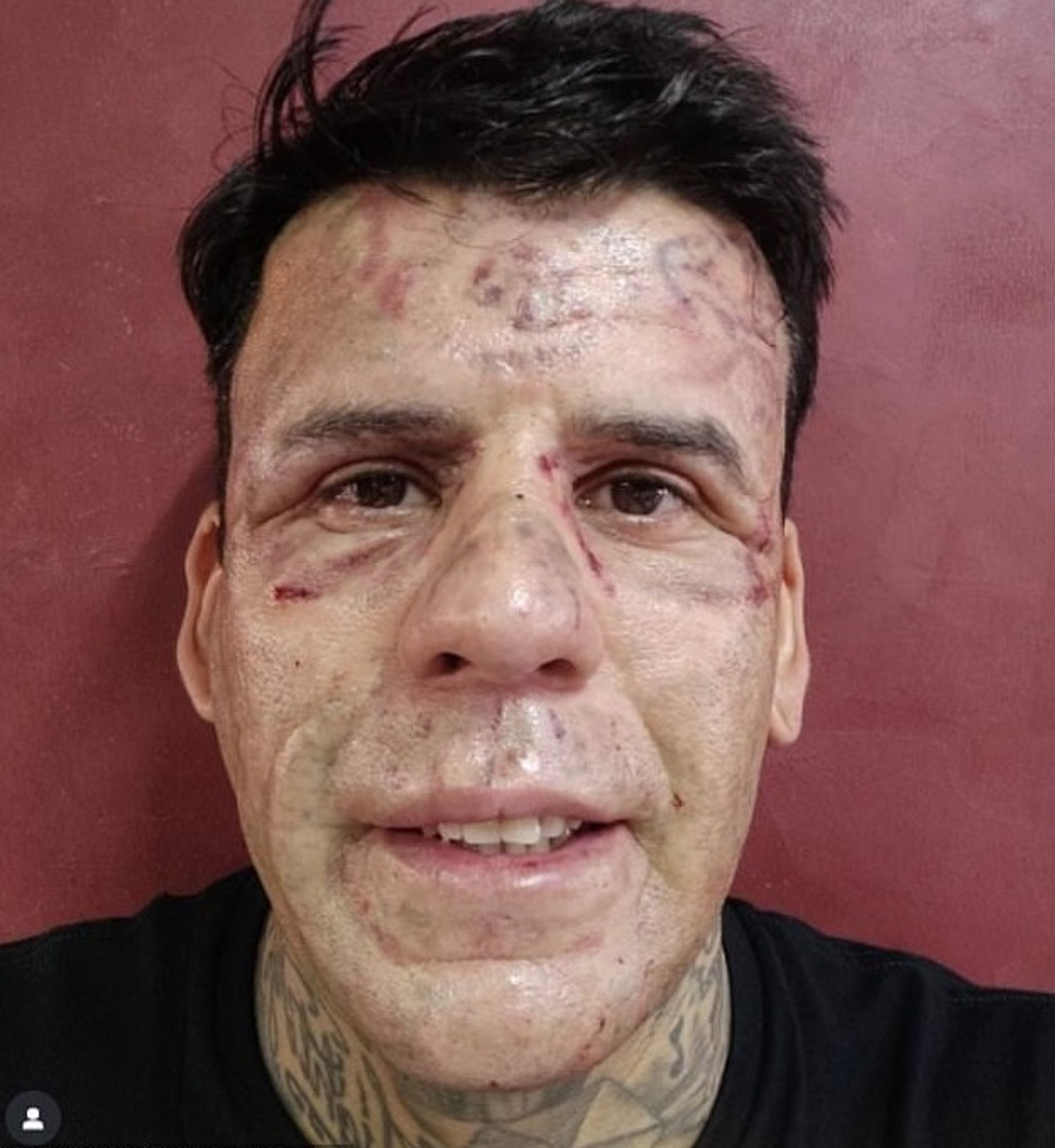 蘇薩接受第5次刺青移除手術後不久的模樣。（圖／翻攝leandrodesouzabless IG）