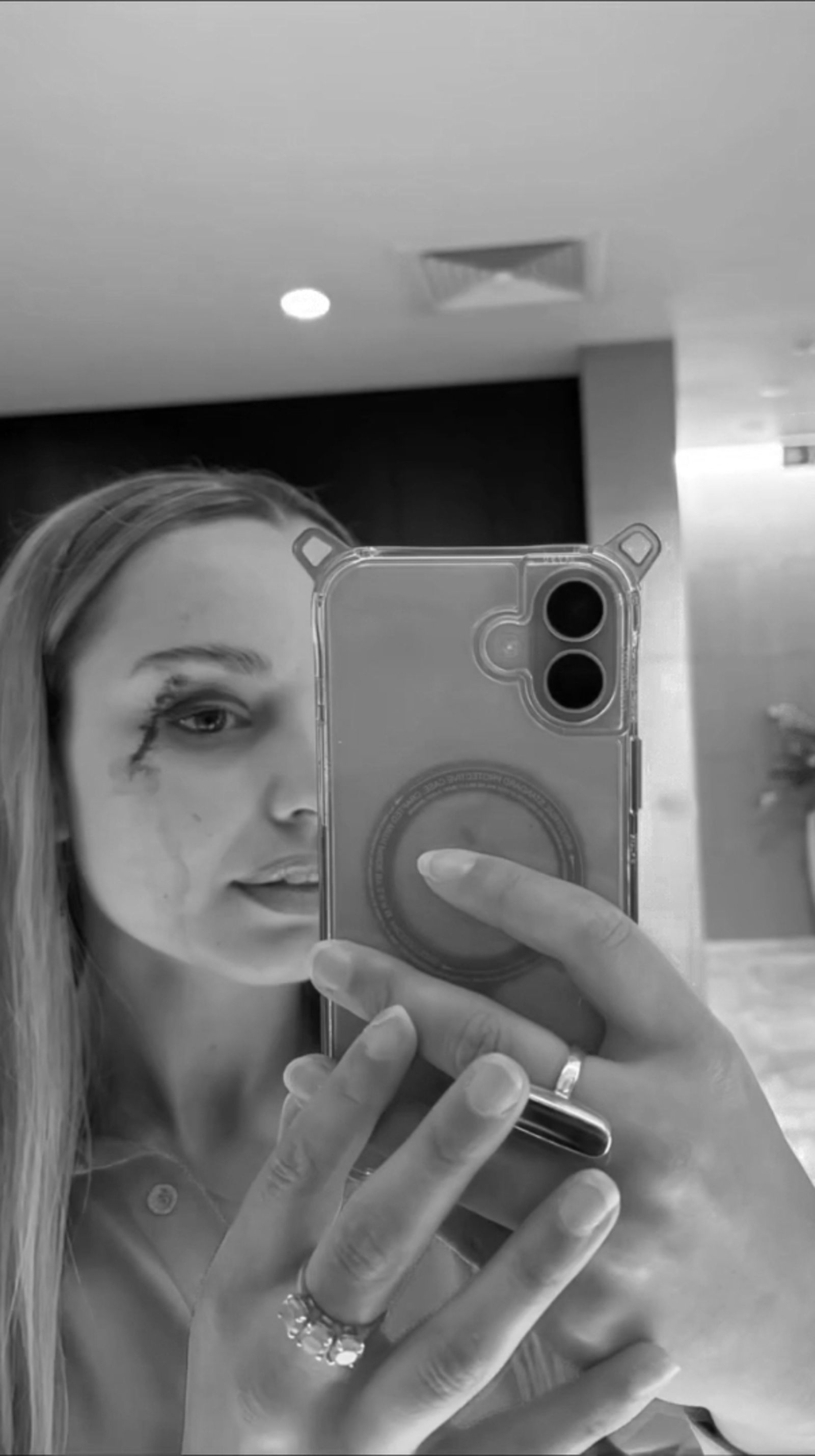 泰森左眼旁留下長長一道血痕。（翻攝IG@jessicatyson08）