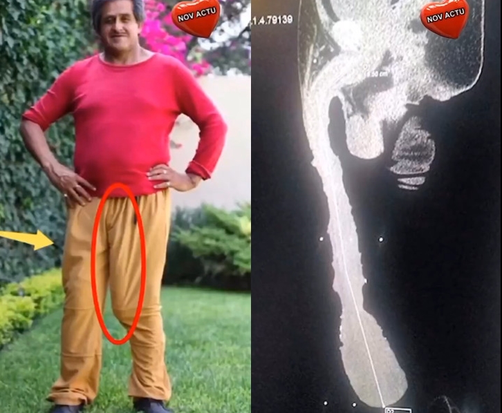 墨西哥鵰王卡布雷拉宣稱擁有48公分巨大陰莖，然而放射科醫師透過電腦斷層檢查卻戳破假象，實際上大多是包皮過長。（翻攝X@the_cruisetv）