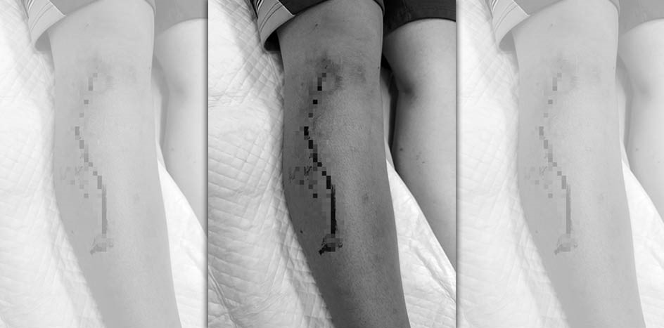 屏東一所國中爆發學生衝突，一名學生被同學用美工刀割傷，縫了12針。（翻攝自臉書）