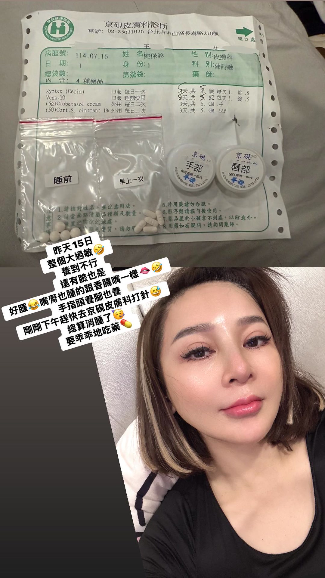王彩樺近日大過敏「癢到不行」，靠打針吃藥才消腫。（翻攝自王彩樺IG）
