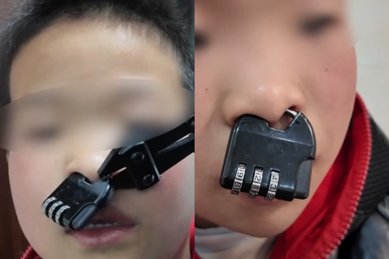 1名男童在玩耍時突發奇想,將手中的密碼鎖環套在鼻中膈上。(翻攝畫面)