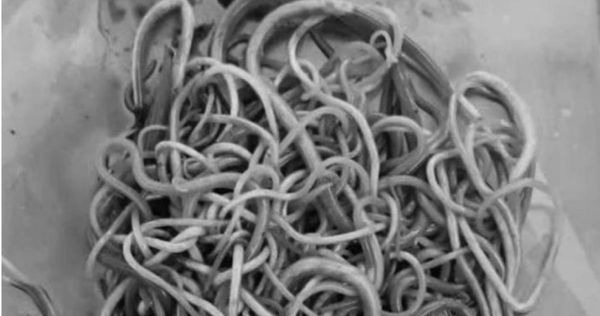 越南一名男童休克送醫，才發現小腸裡竟有上百條蛔蟲。（翻攝自X）