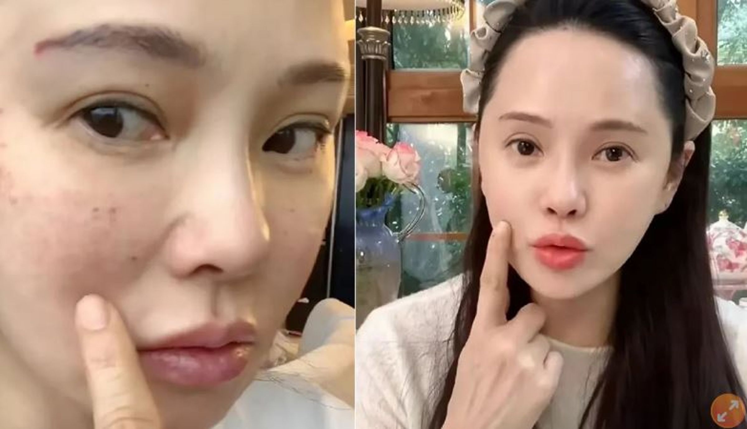伊能靜在小紅書分享去做了醫美打水光針,並秀出打完後第2天滿臉針孔的照片。(翻攝自伊能靜小紅書)