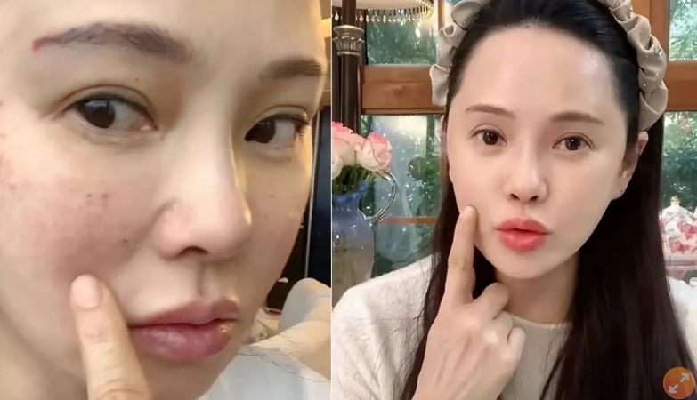 伊能靜在小紅書分享去做了醫美打水光針,並秀出打完後第2天滿臉針孔的照片。(翻攝自伊能靜小紅書)