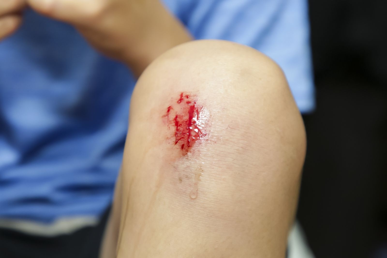 大部分人都錯了!傷口結痂不是快癒合 整形醫師:反而會留疤