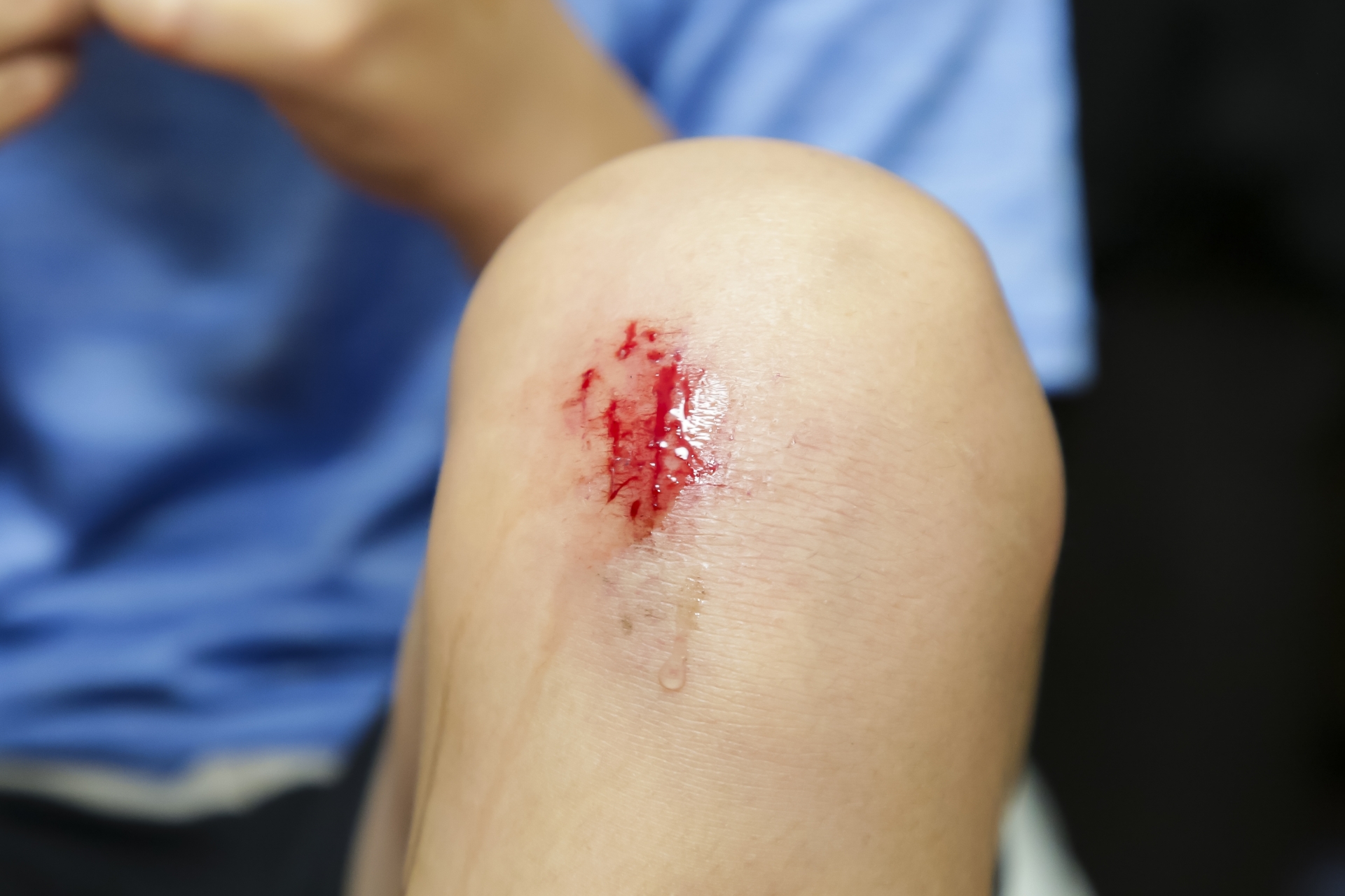 醫生建議受傷若不想留疤,第一天就要清創,並貼上人工皮維持濕潤環境。(示意圖,photoAC)