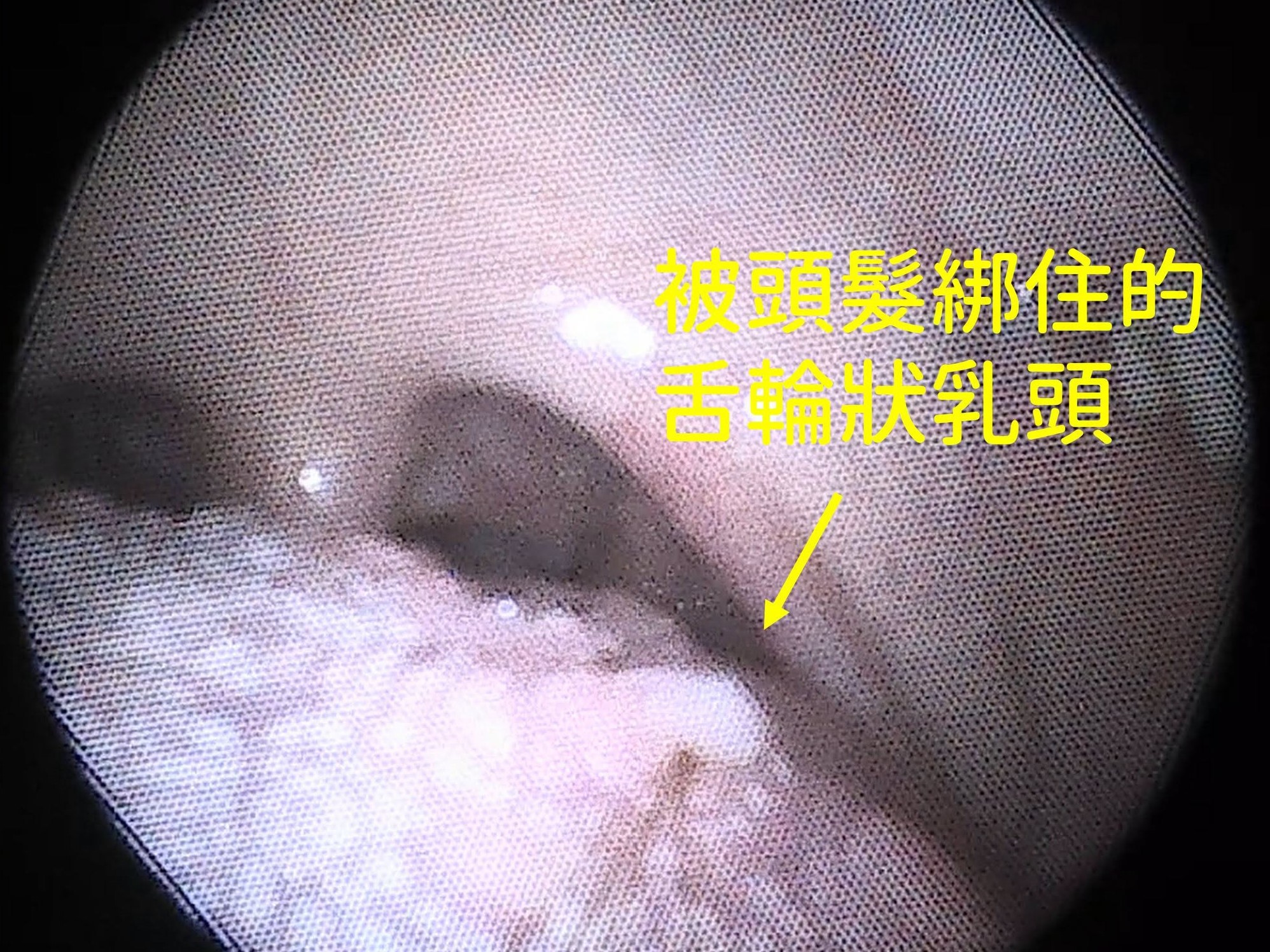喝飲料後舌頭卡卡！竟是頭髮在味蕾打結　醫示警：切勿自行硬拿