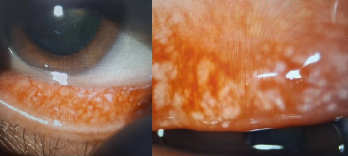 透過裂隙燈檢查可發現，嚴重的眼結石會突出結膜表面，如砂紙般反覆摩擦角膜，若不即時處理恐引發角膜潰瘍。（洪啟庭提供）