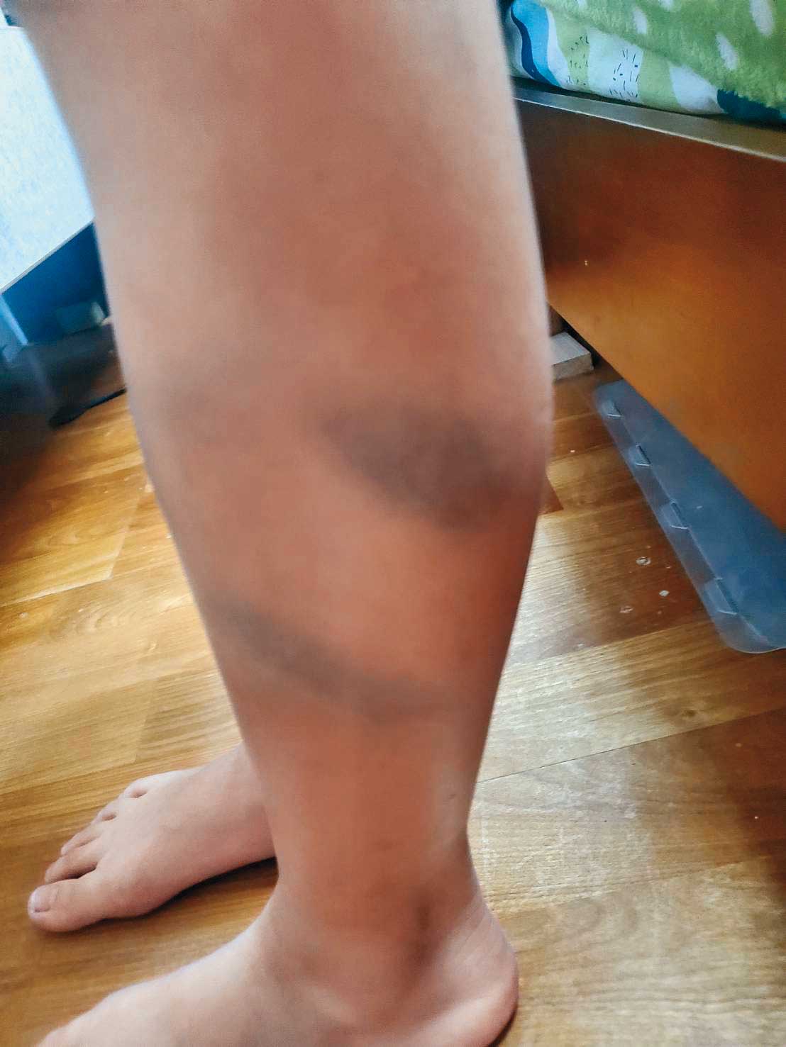 補習班學生因為頑皮不聽話，竟遭情緒失控的老師打到全身瘀傷。（讀者提供）