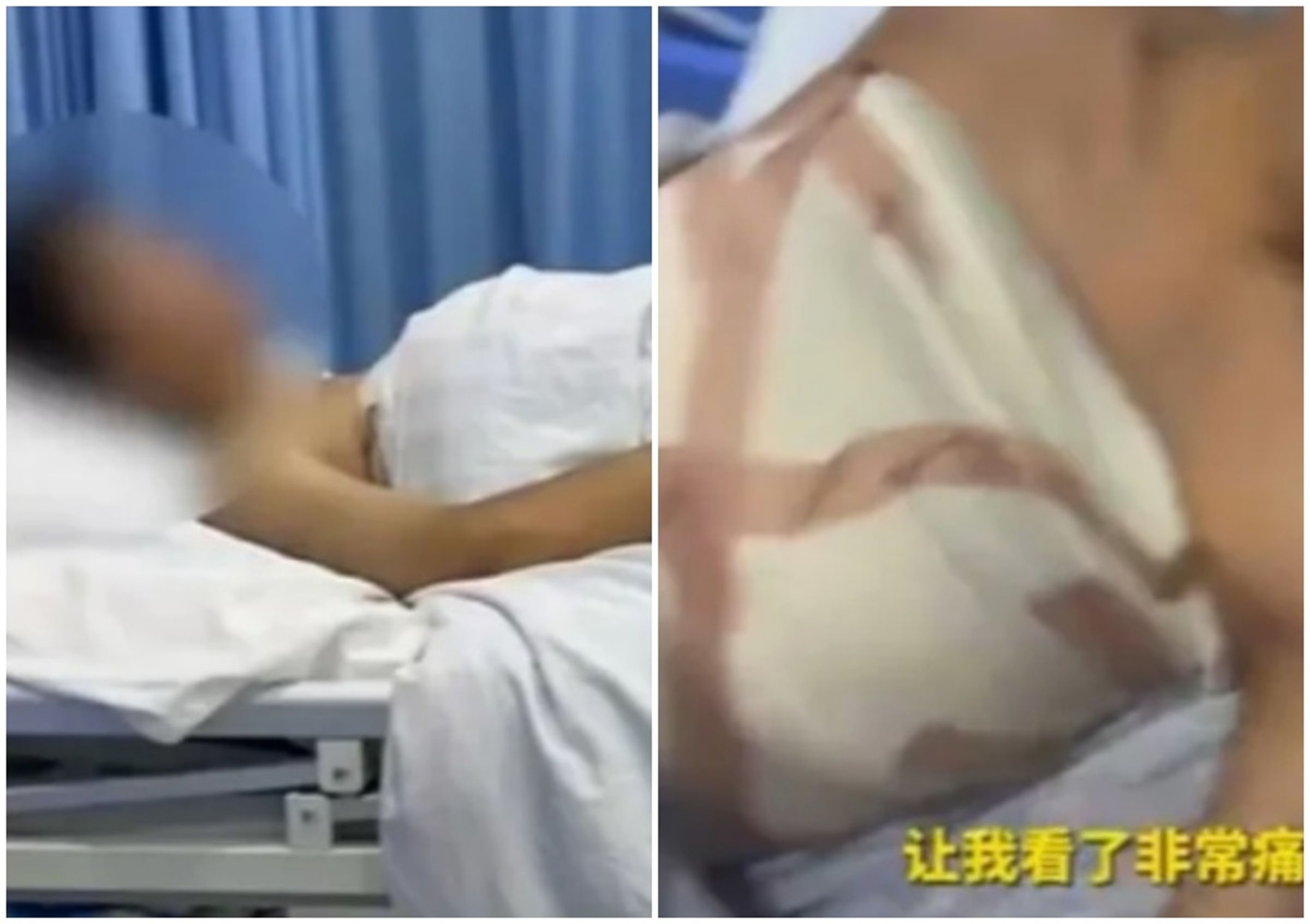 中國一名19歲男子前往一間醫美診所求職,每想到竟被對方連哄帶騙「隆乳」。(翻攝自微博)