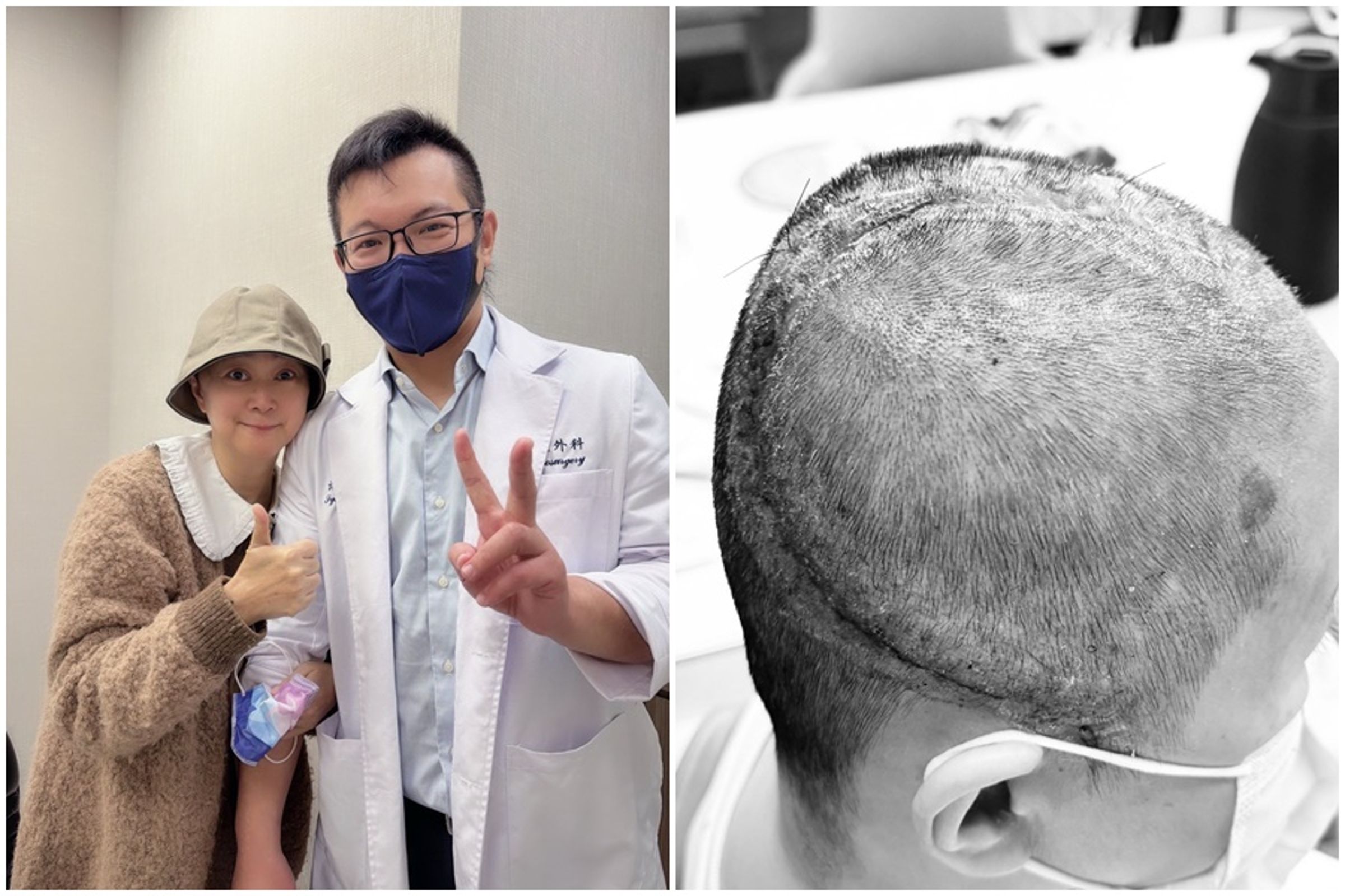 王月發文公開術後傷疤，並向萬芳醫院醫療團隊與執刀醫師致上最深的感謝。（翻攝自王月臉書）