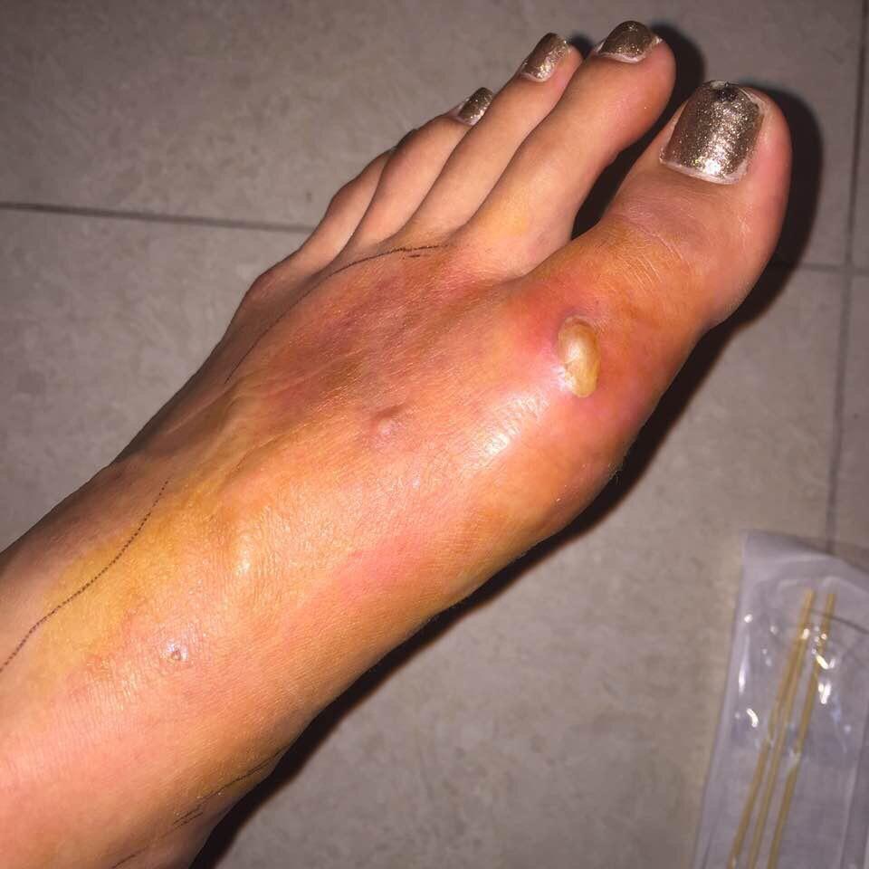 韓國籍模特兒朴秀希拍攝廣告時因高跟鞋過小,導致左腳蜂窩性組織炎急診。(圖/朴秀希提供)