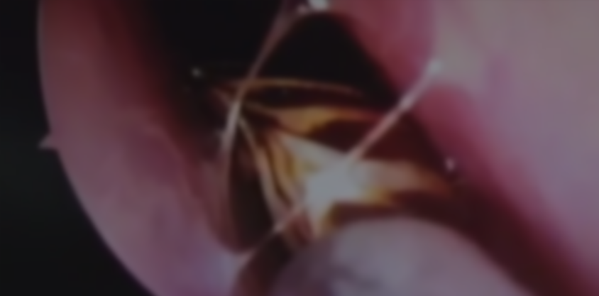 睡覺建議戴帽？印度婦人眼睛痛　蟑螂爬進腦