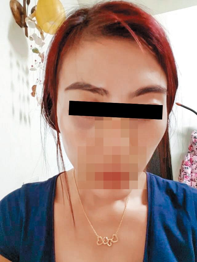 陸配小珍長期遭到先生暴力相向，眼眶布滿大瘀青。