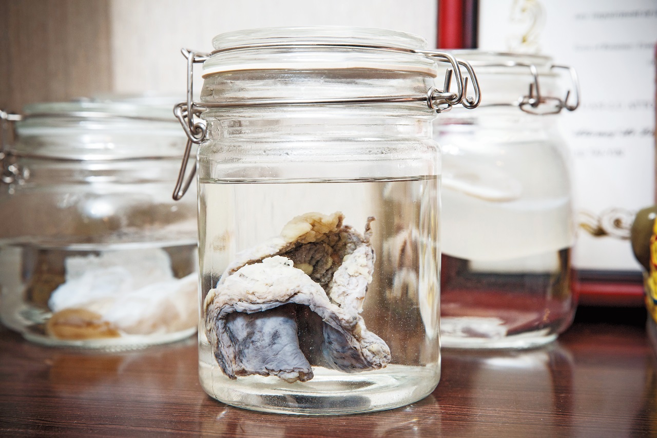 現在隆乳手術常用果凍矽膠當填充物，若術後照顧不良，就會發生莢膜攣縮（圖），得動手術取出。