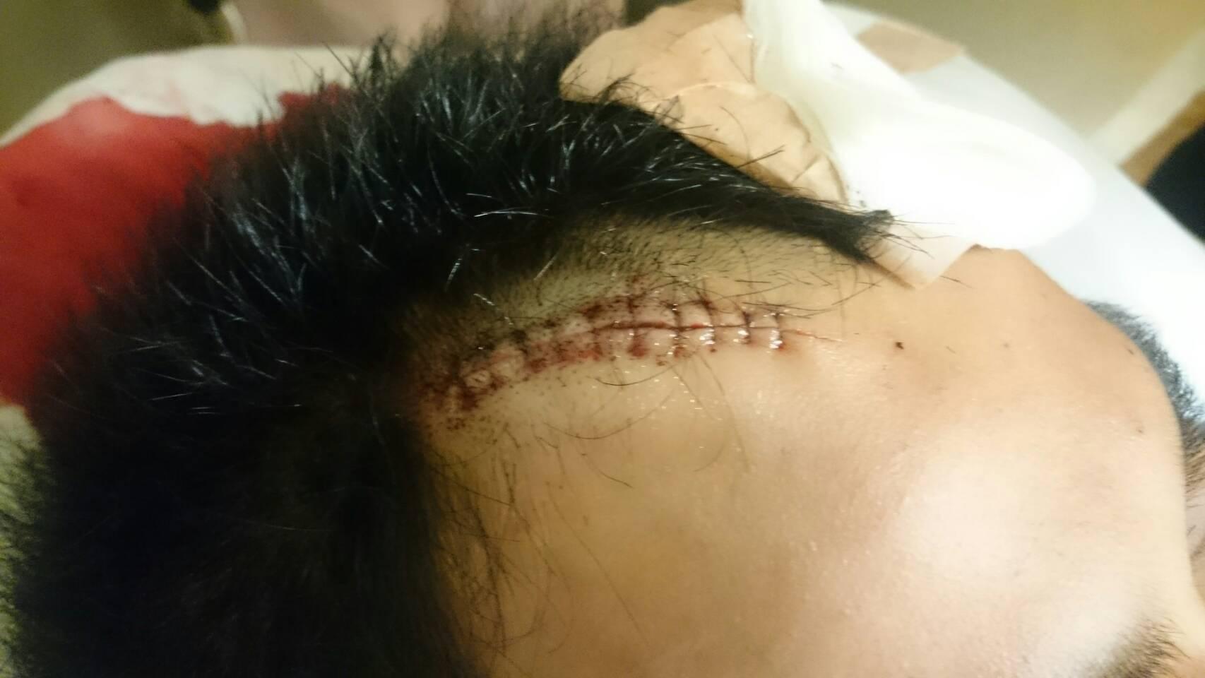 劉員頭部縫了約20針，所幸無生命危險。
