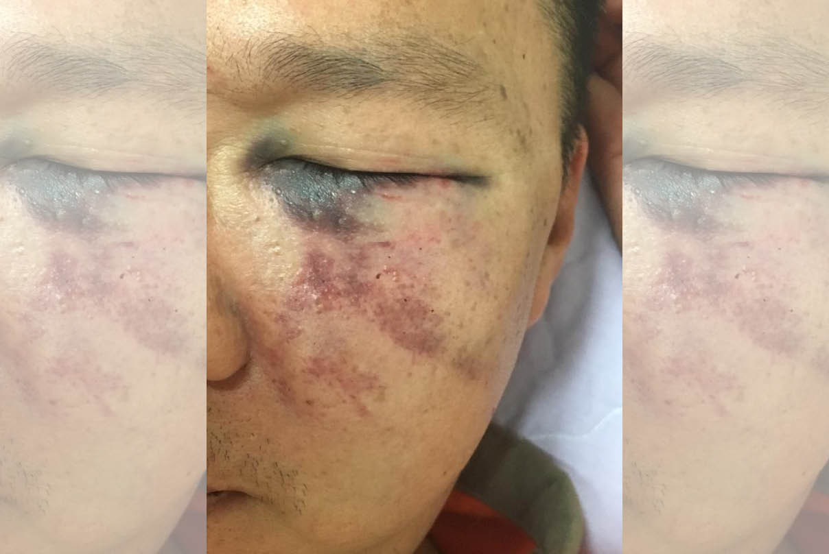 蕭姓男子接小孩卻被打到住院，其親屬將傷勢放上網路提醒民眾注意。