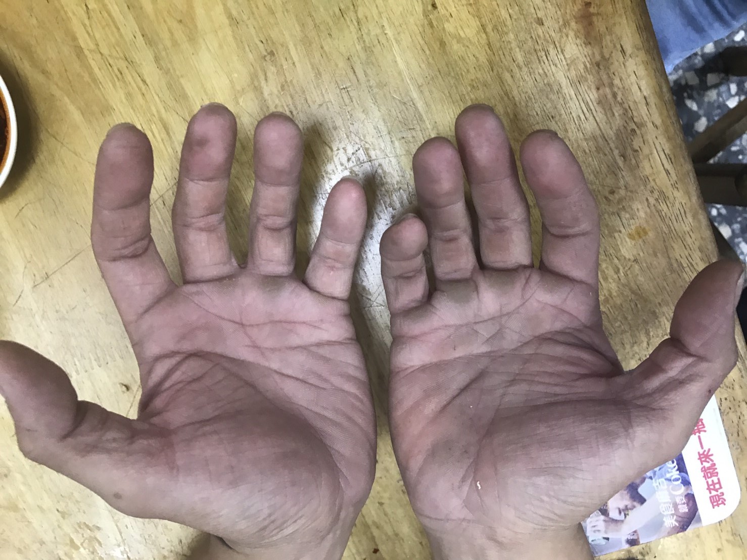 因為長年刷洗,羅緯文雙手的硬繭連醫美診所的液態氮都無法去除。(羅緯文提供)