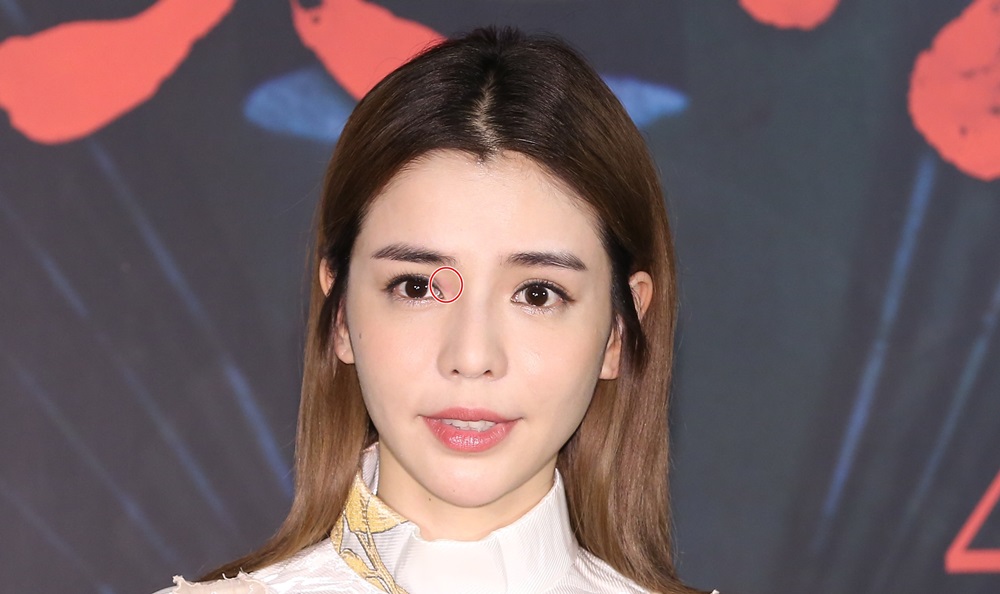 李毓芬突然眼睛過敏，發生泛紅現象（紅圈處）。