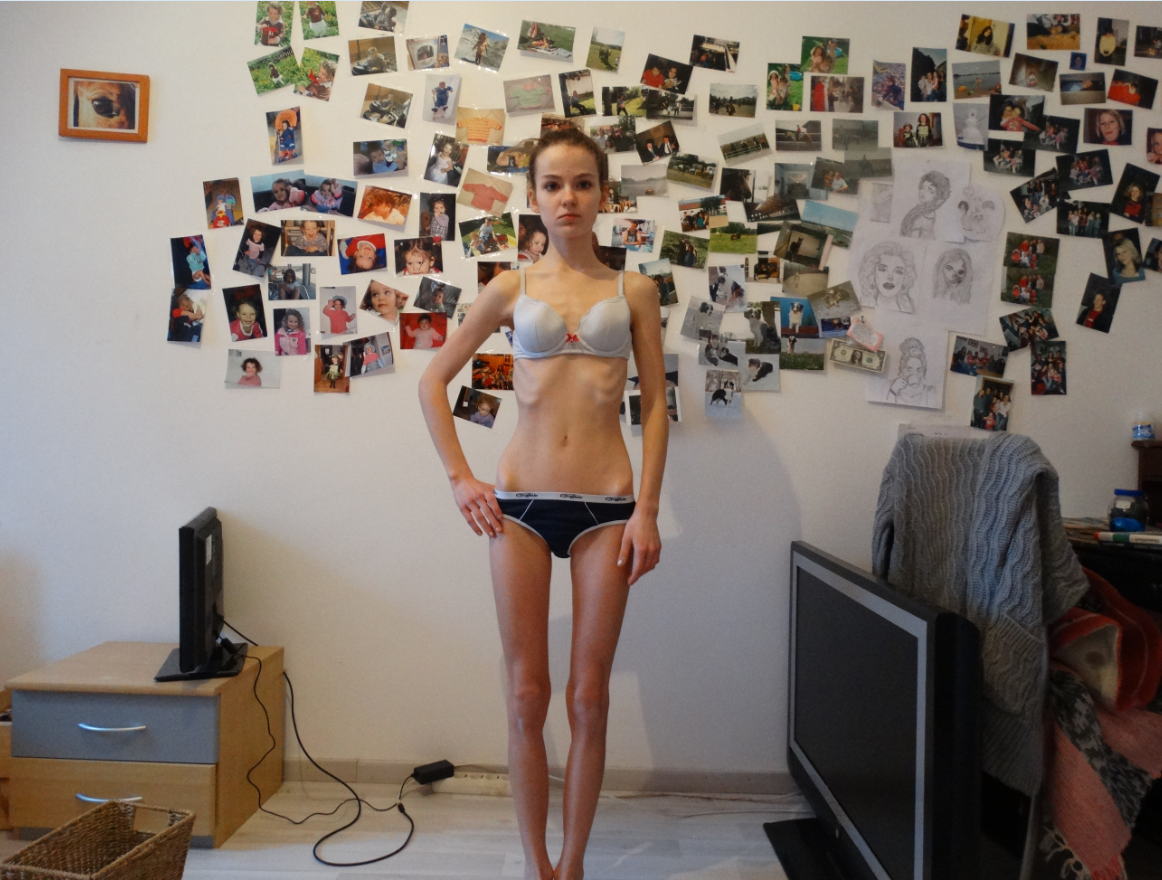 15歲德國少女Lina Baier一度罹患厭食症，差點餓死自己。（東方IC）