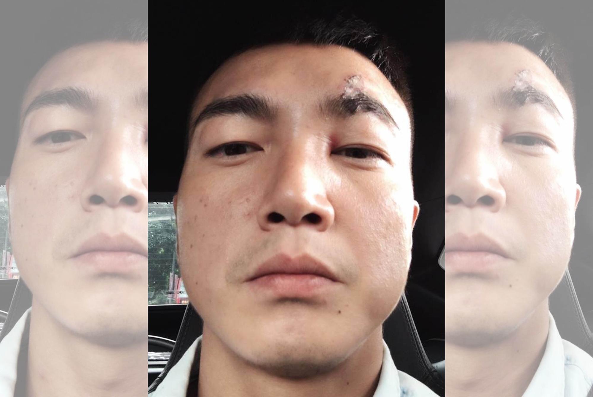 李沛旭身為《只為你停留》男主角卻刻意缺席殺青酒,表達「無言的抗議」,之前他拍戲受傷,左眉破相。(翻攝網路)
