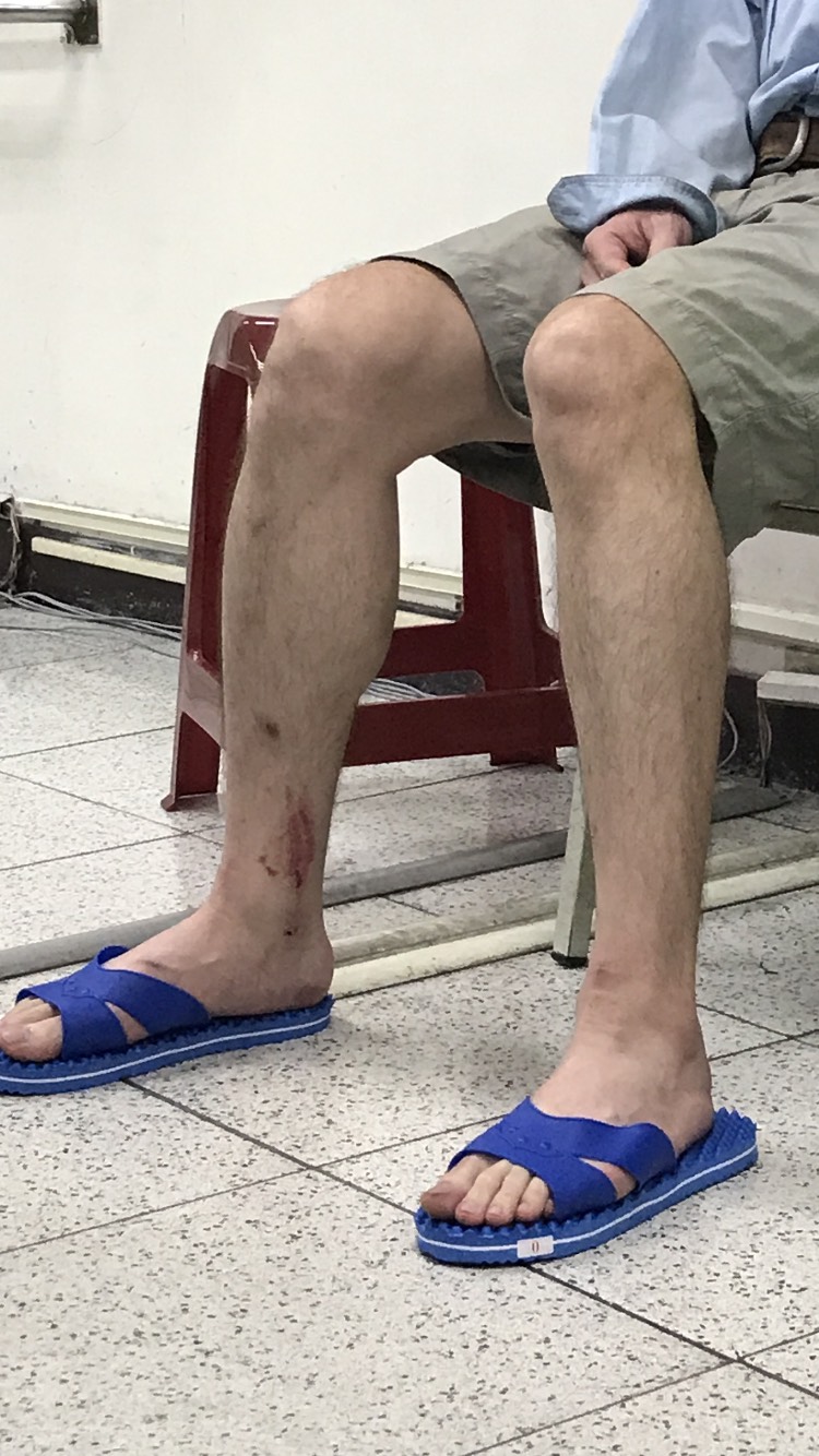 陳嫌腳上還有先前和遊民打架所留下的傷痕。