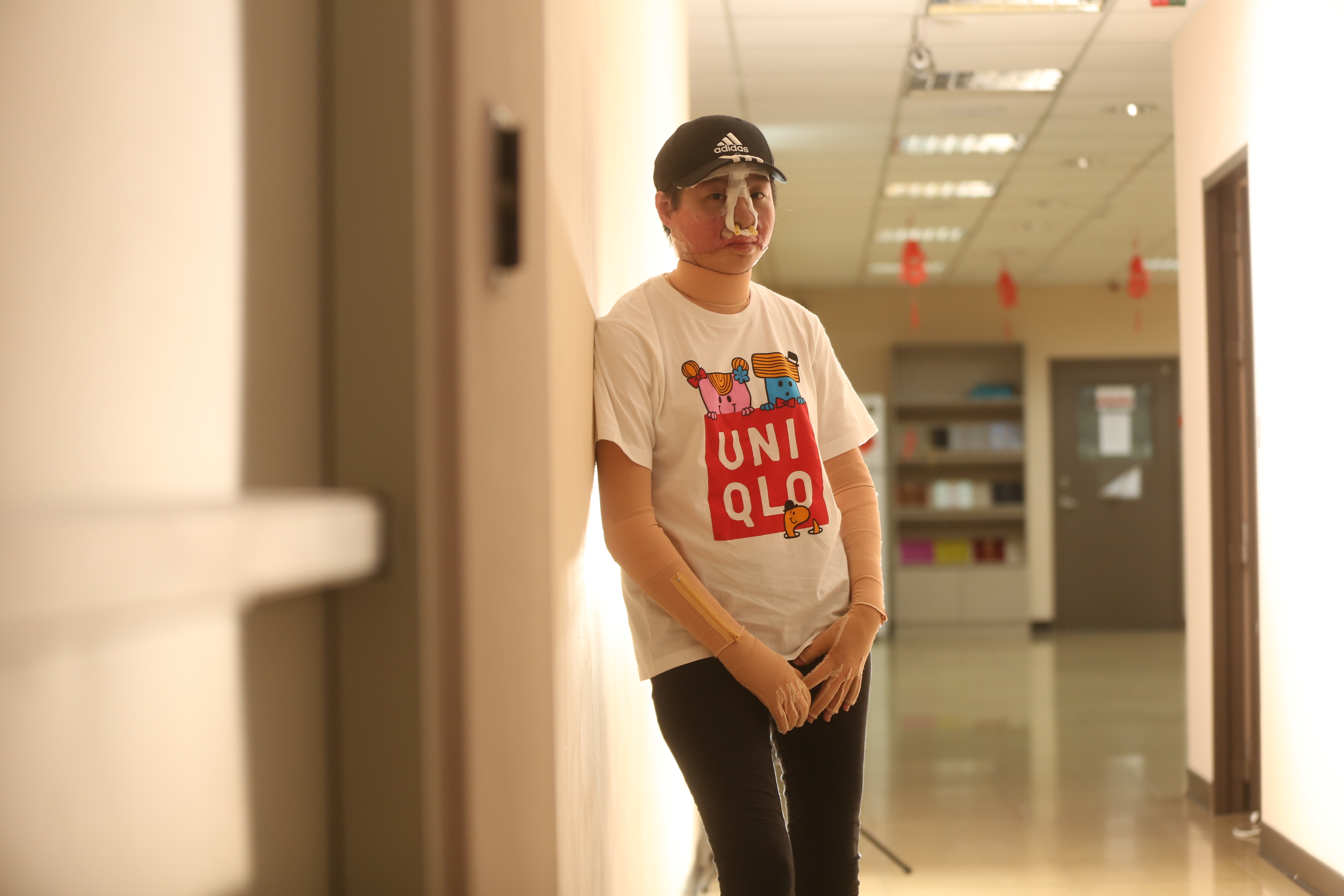 陳依欣怕熱，在重建中心是出了名的，她穿著壓力衣讓我們拍照，一熱皮膚就癢。