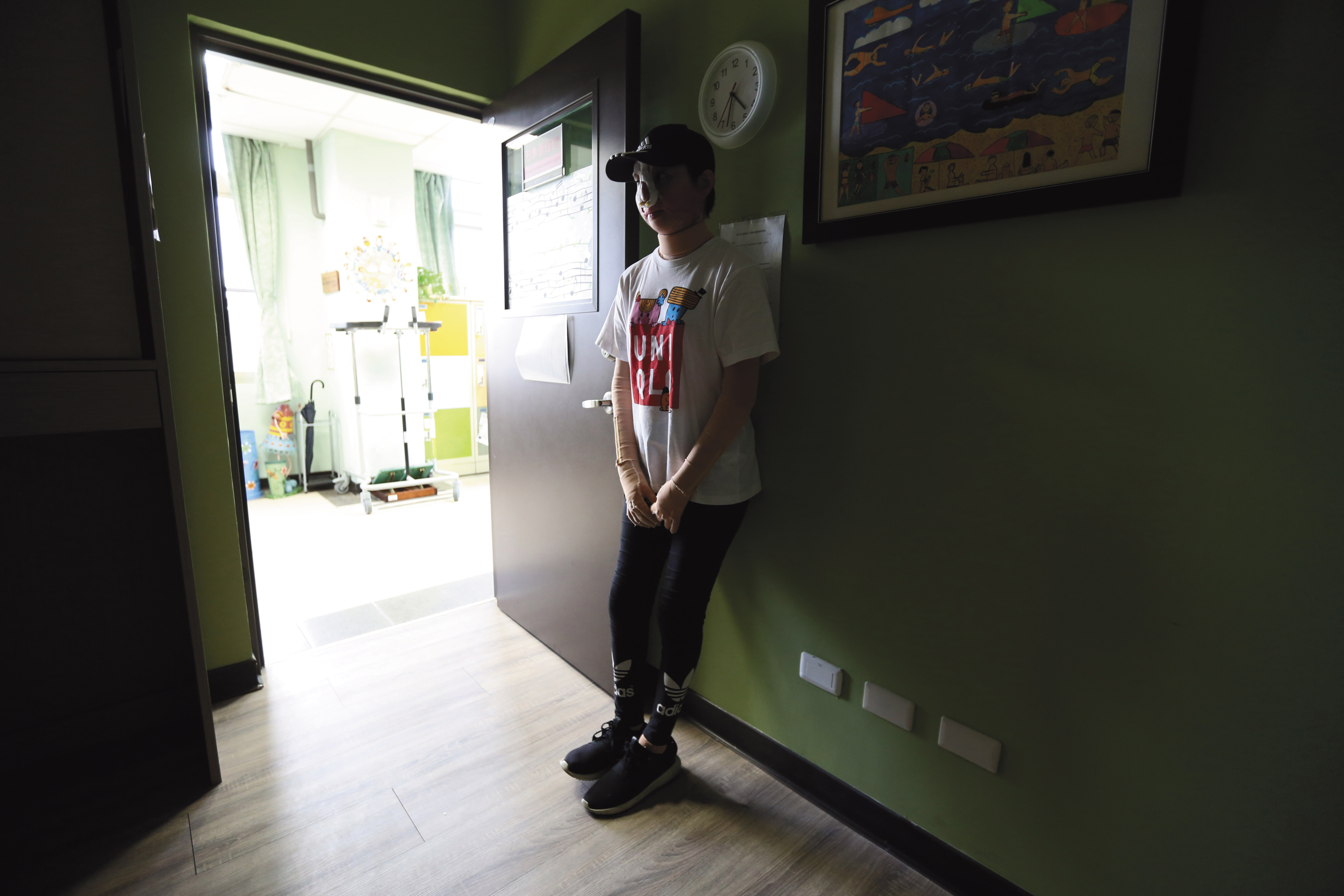 陳依欣剛動完以耳骨和頭皮做的鼻子重建手術,一開始還有點介意被拍到正面。