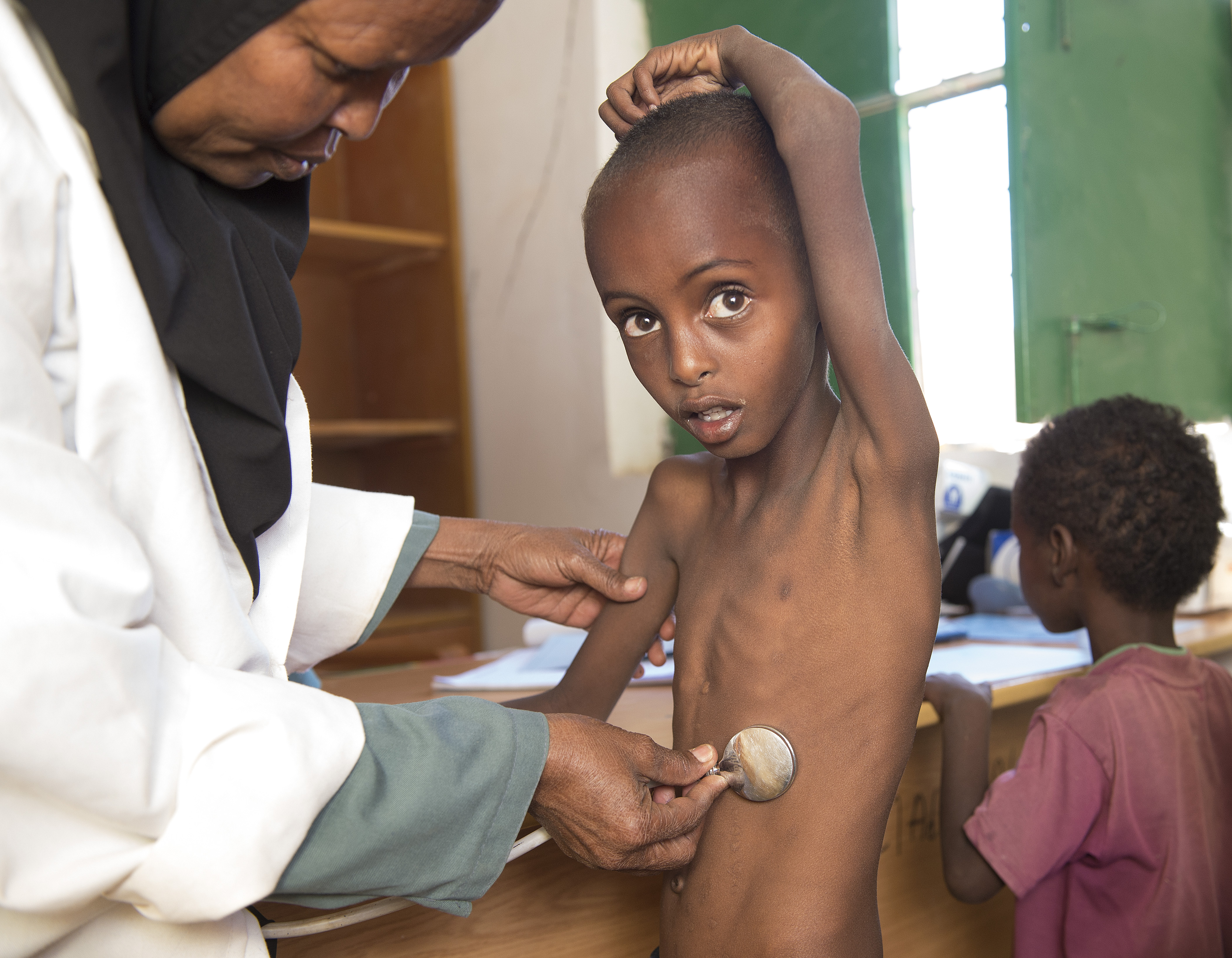 索馬利亞面臨飢荒，導致五歲男童Abdulahi 嚴重營養不良。（東方IC）