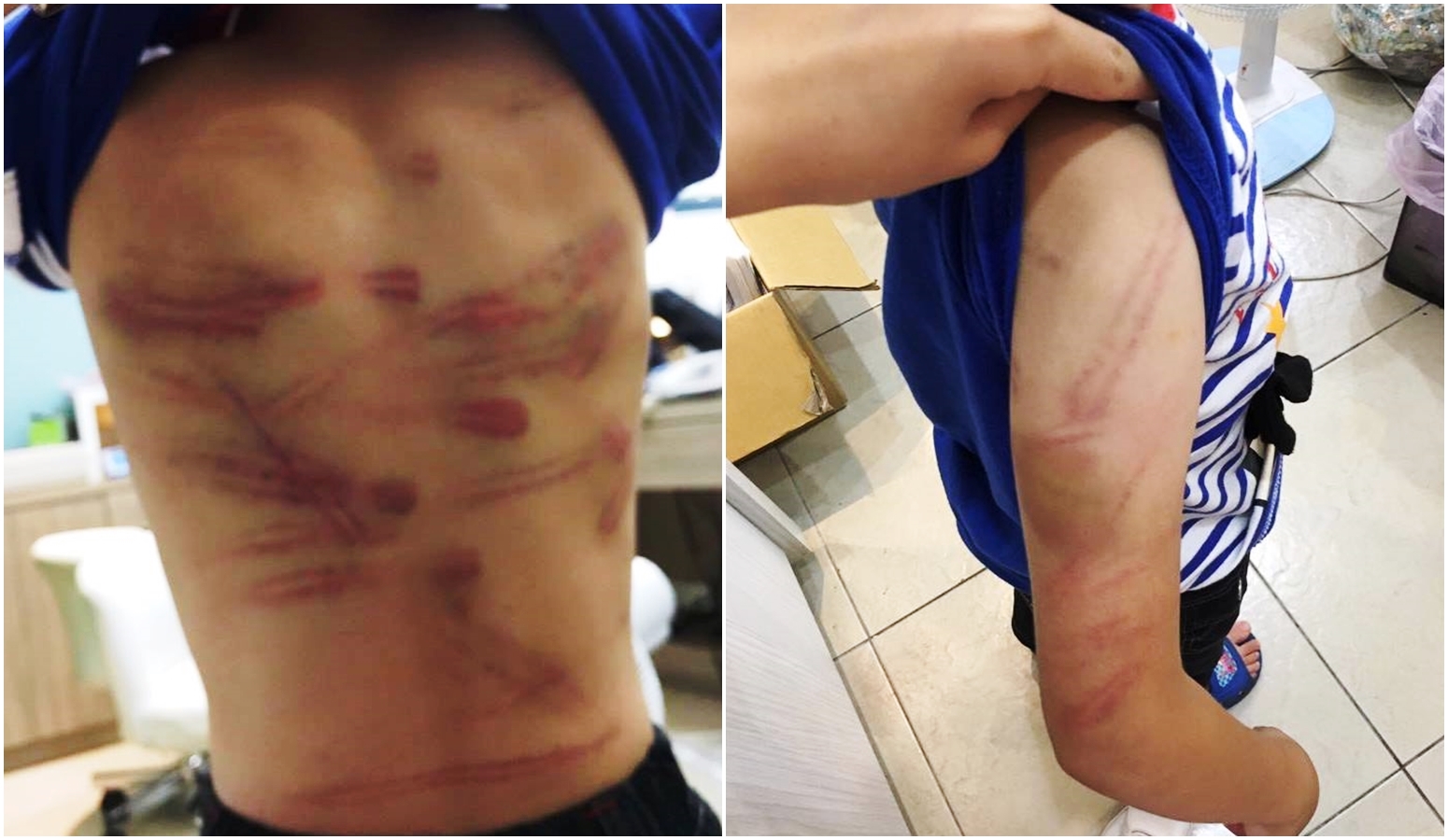 7歲男童被父親女友暴打成傷，被網友發現報警。男童滿身是傷，令人心疼。（翻攝畫面）