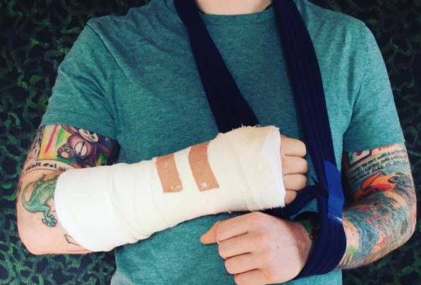 紅髮艾德騎車受傷，po出打石膏的傷勢照。翻攝自Ed Sheeran臉書
