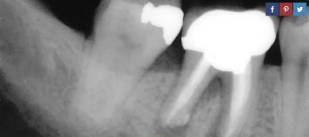 根管治療終結者！幹細胞填充物能使牙齒進行自我修復
