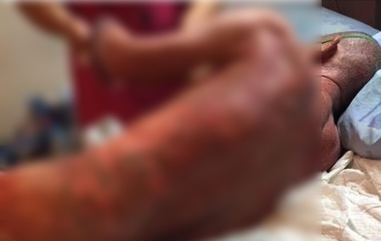 病患術後引發強烈過敏反應，導致傷口紅腫潰爛。（翻攝自網路）