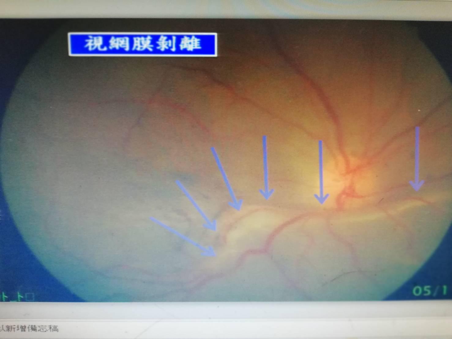 因國人長時間使用手機，造成視網膜病變，也就是視網膜剝離的前期症狀，不提早治療恐失明。（洪啟庭醫師提供）