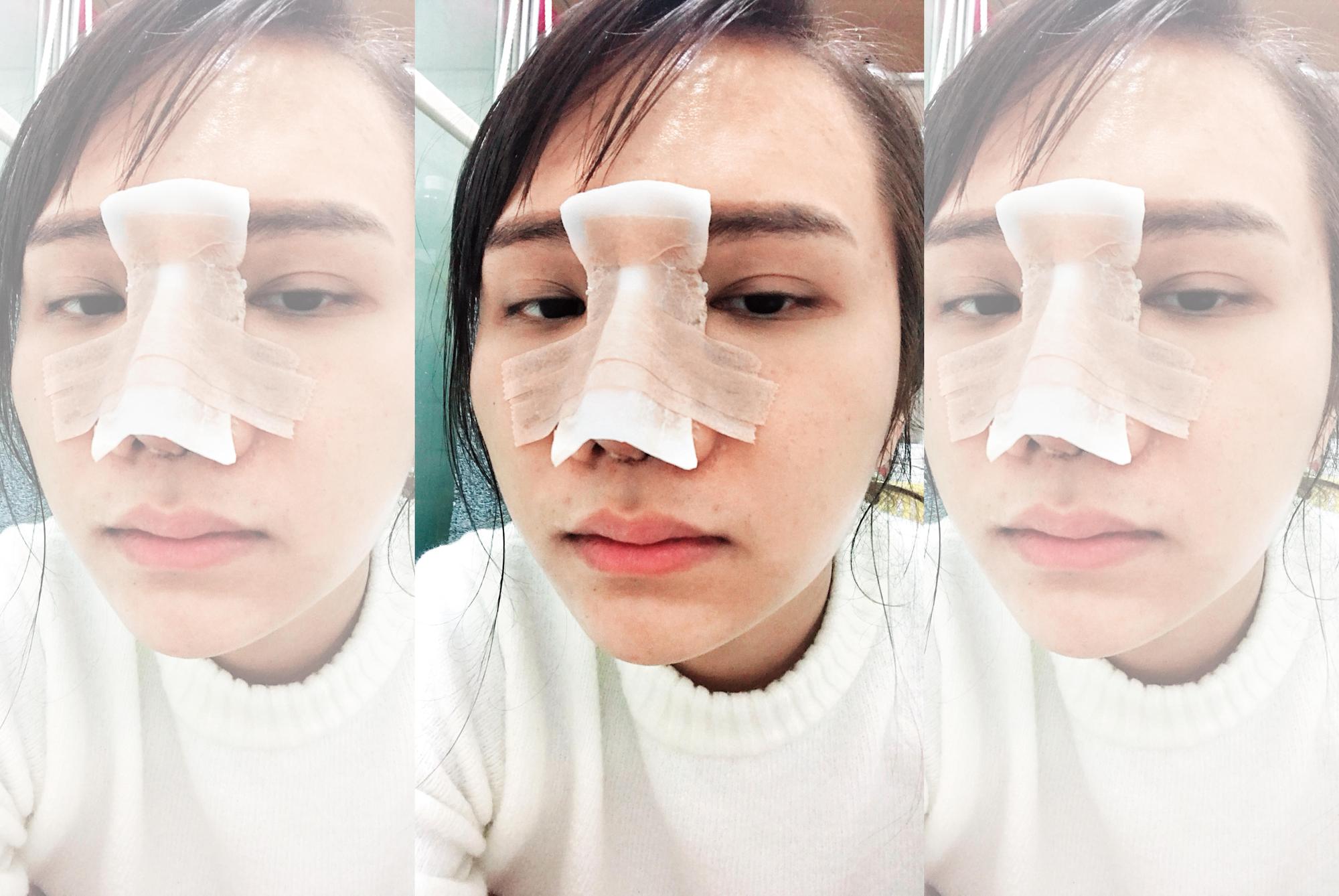 小A辣做完隆鼻手術後恢復中的休養照。(小A辣提供)