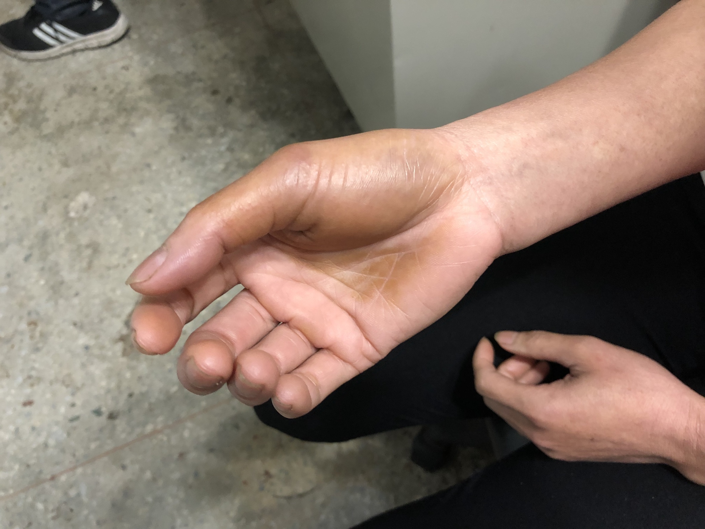 逃逸外勞被黃嫌毆打，導致手部有瘀青。（新北市專勤隊提供）