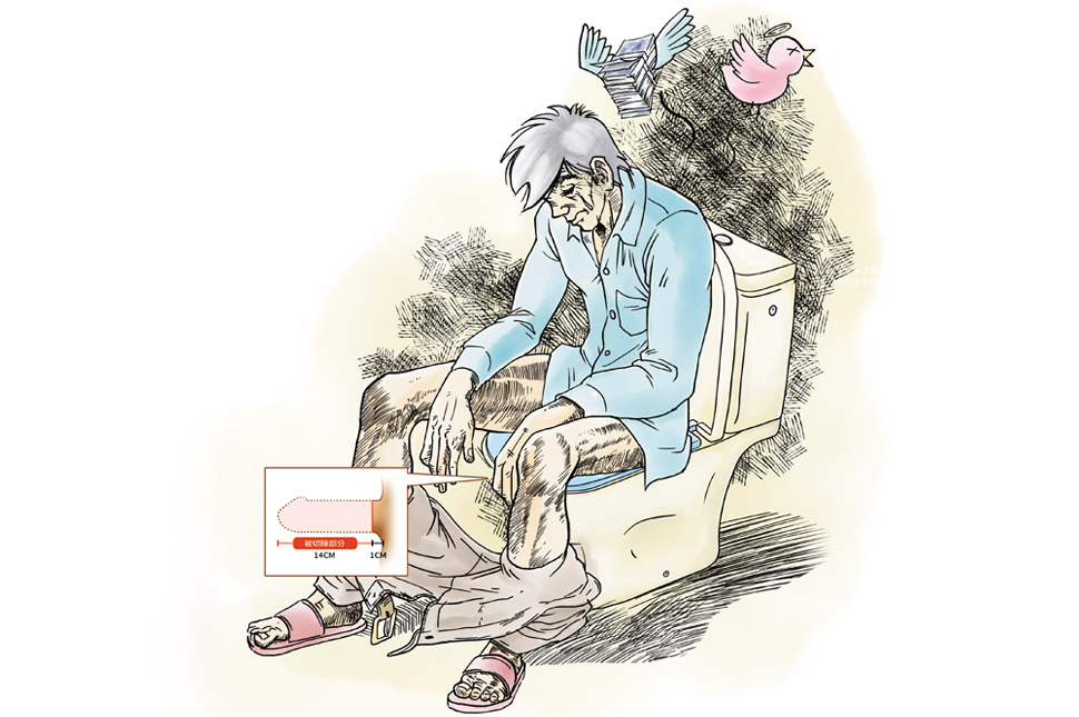 王姓男子攝護腺開刀後性功能不佳，裝人工陰莖後卻整支爛掉，切到只剩1公分，只能坐著尿尿。