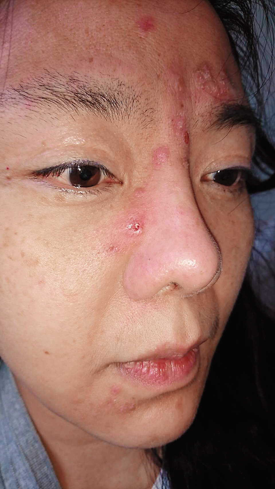 小潘潘最近傳給友人的照片,可以明顯看出長了很多痘痘,有免疫力失調跡象。(小潘潘友人提供)
